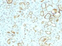 FFPE human renal cell carcinoma sections stained with 100 ul anti-STAT6 (clone STAT6/2410) at 1:400. HIER epitope retrieval prior to staining was performed in 10mM Citrate, pH 6.0.